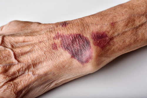 Skin Breakdown Prevention course image